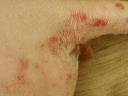 螨蟲與真菌混合感染性皮膚病治療