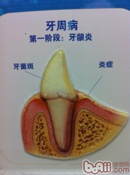 牙菌斑带来的危害