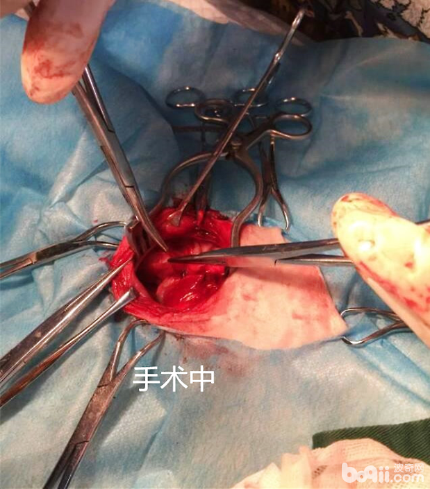 主动脉弓缩窄手术图片